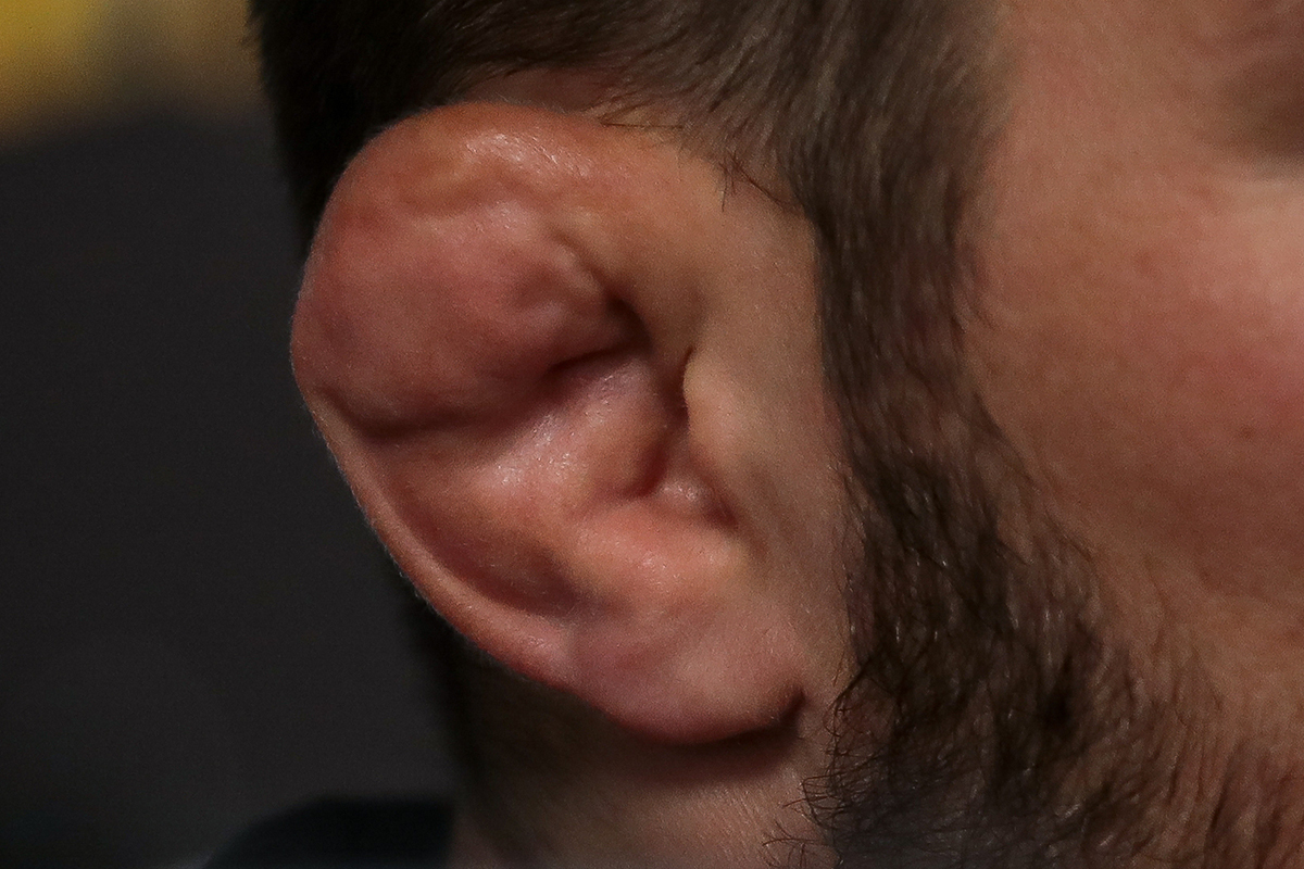 К каким последствиям может привести перелом уха? | АиФ Ставрополь
