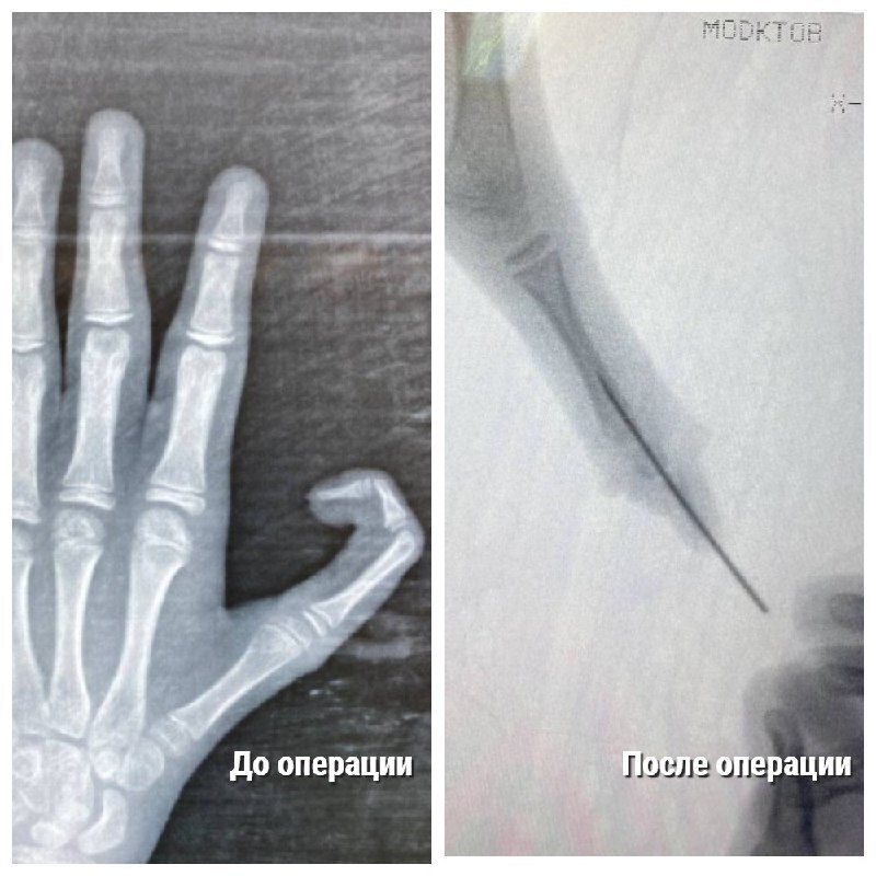 Подмосковные врачи удалили лишнюю фалангу пальца 10-летнему мальчику
