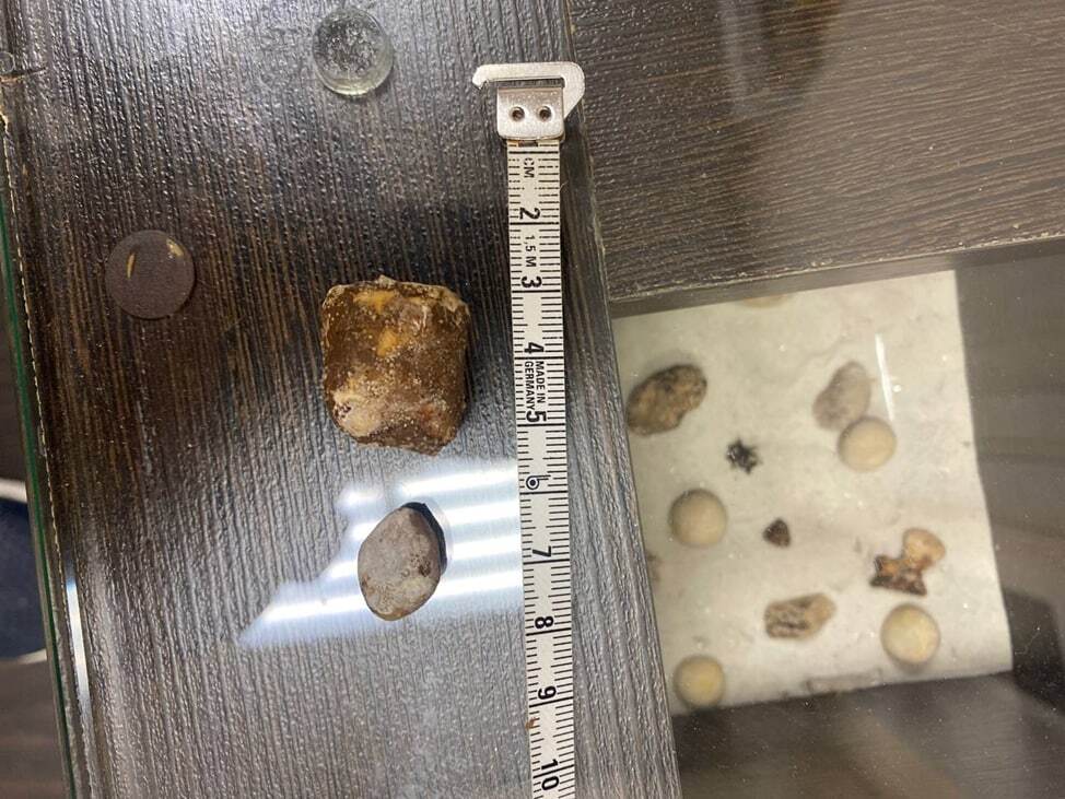 Подмосковные врачи удалили двухсантиметровый камень из почки пенсионерки