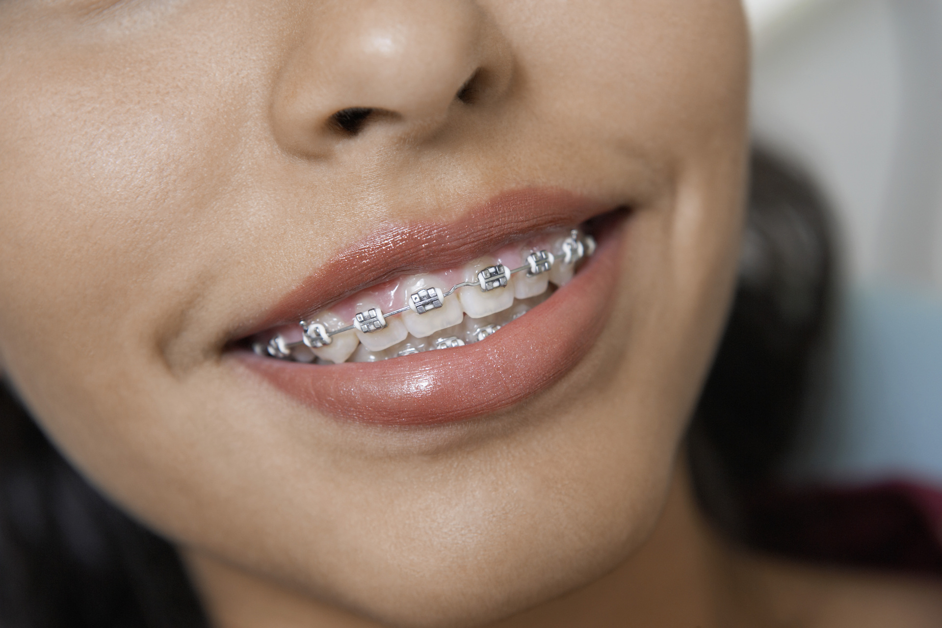 Стоматолог Марафуди посоветовала при ношении брекетов чистить зубы после каждого приема пищи