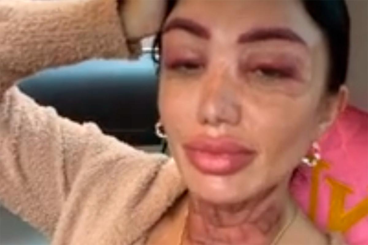 Московский косметолог показала на видео последствия удаления татуажа с лица