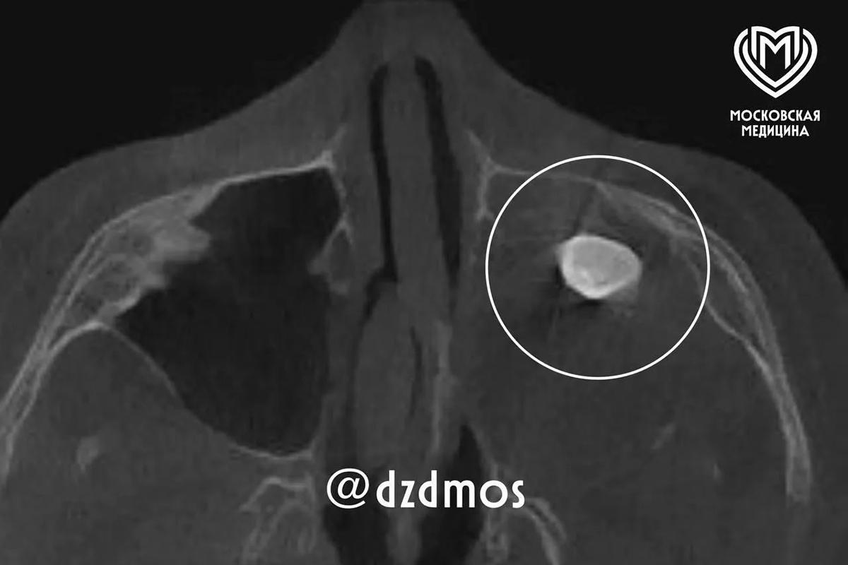 У москвича нашли зуб в неожиданном месте