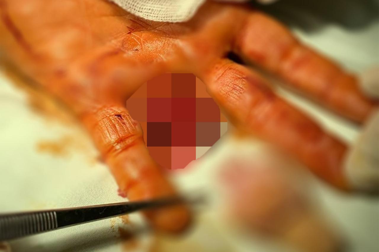 Мужчина сам привез оторвавшийся палец в подмосковную больницу