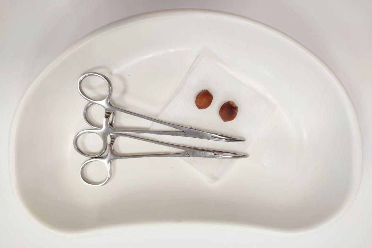 Подмосковные врачи достали из носа пятилетней девочки орехи