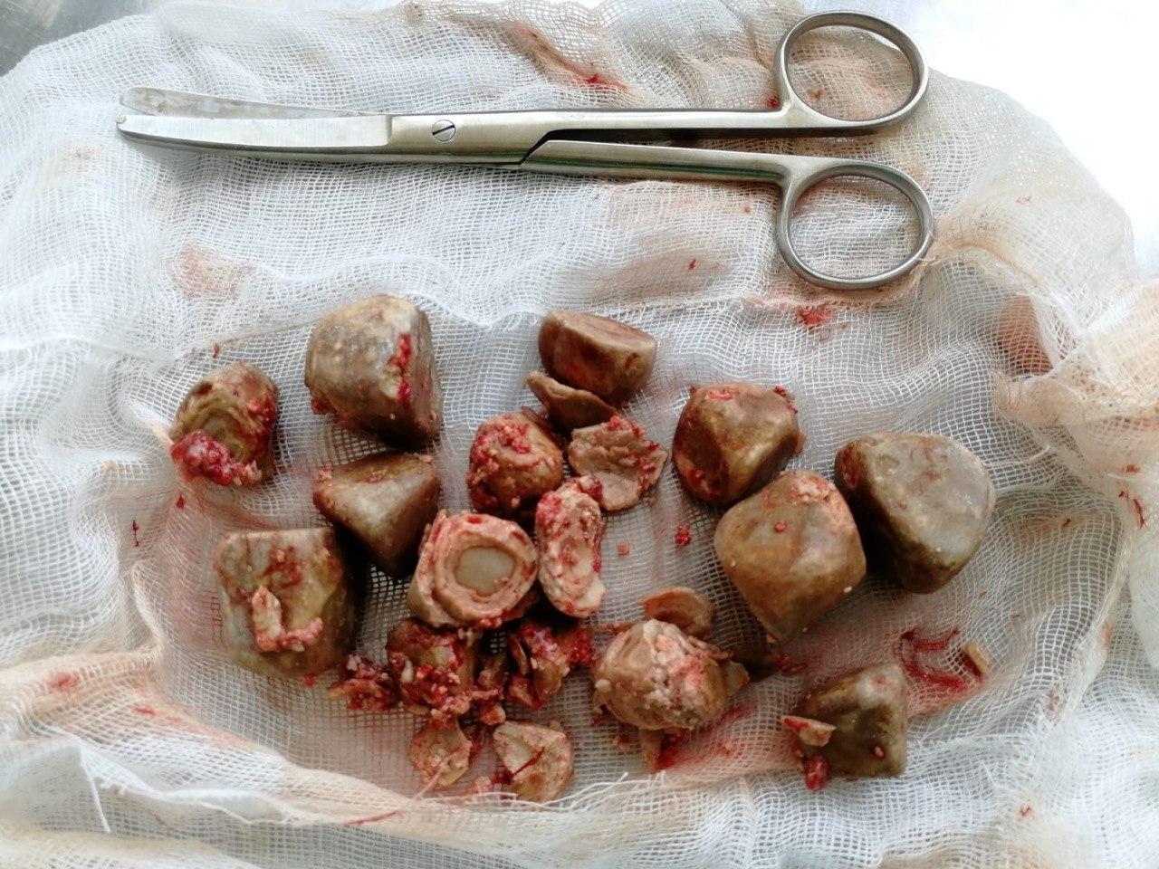 Подмосковные врачи извлекли 300 граммов камней из мочевого пузыря пациентки