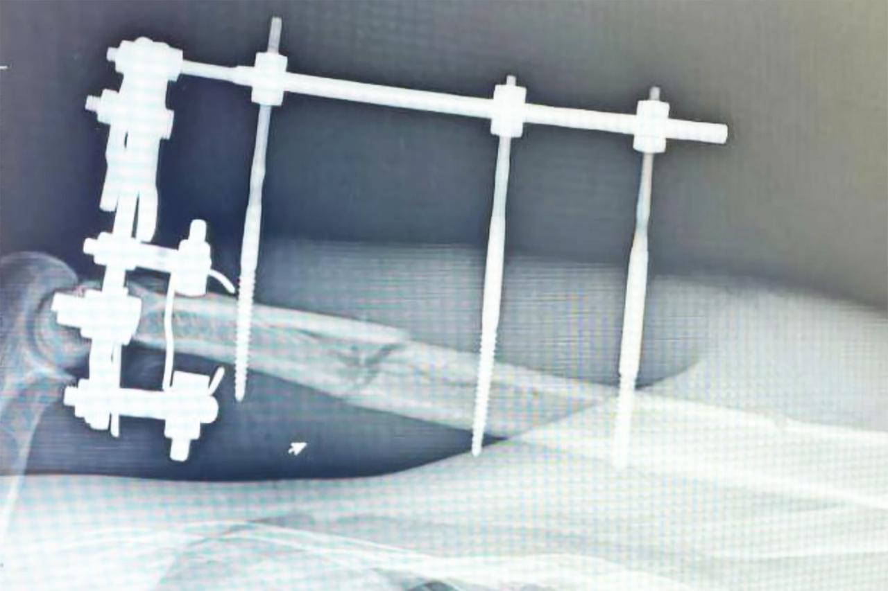 В Подмосковье мотоциклисту спасли почти оторванную руку