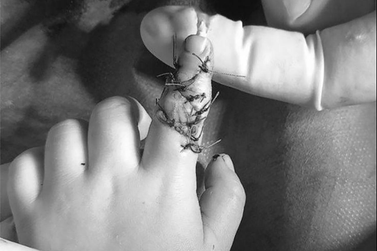 В Подмосковье врачи сохранили ребенку поврежденный эскалатором палец