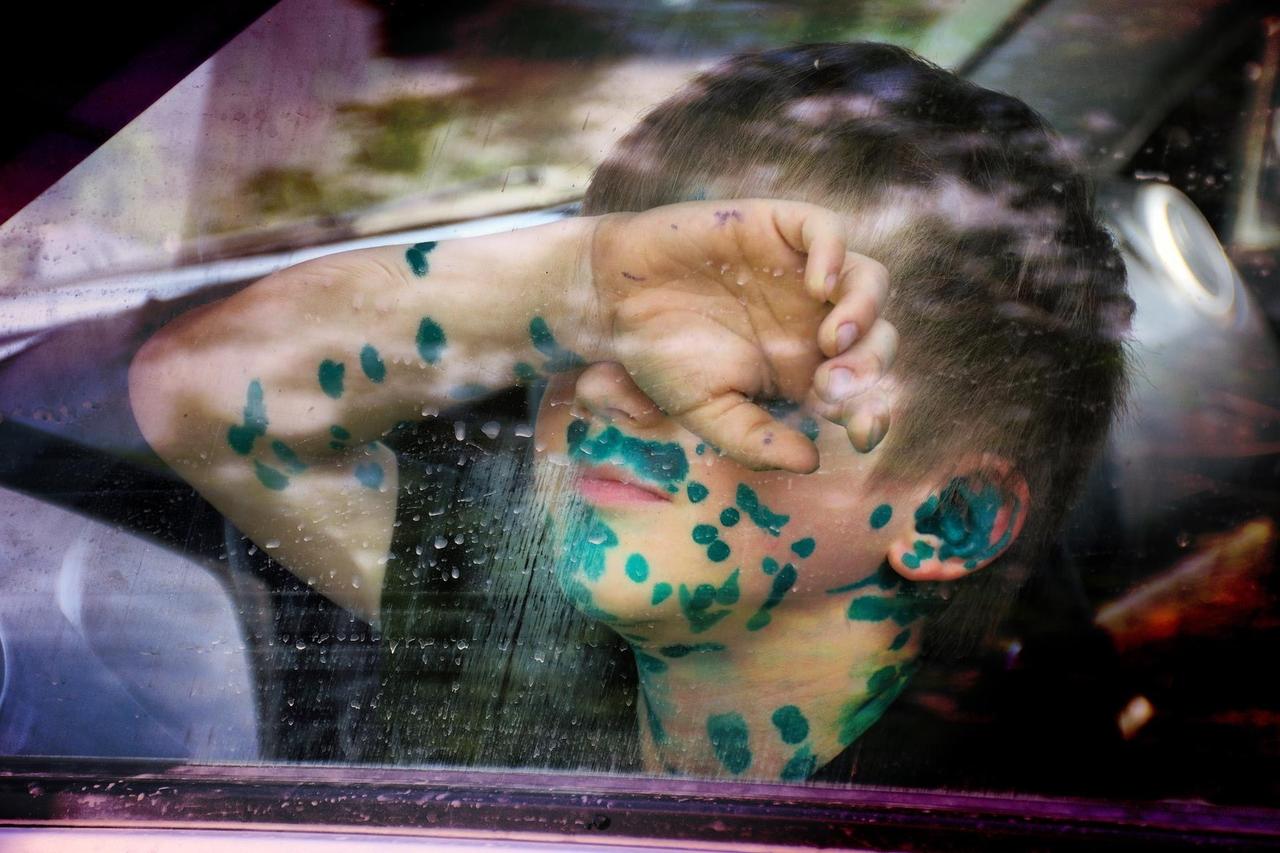 Родители стали специально заражать детей ветрянкой. Зачем они это делают?