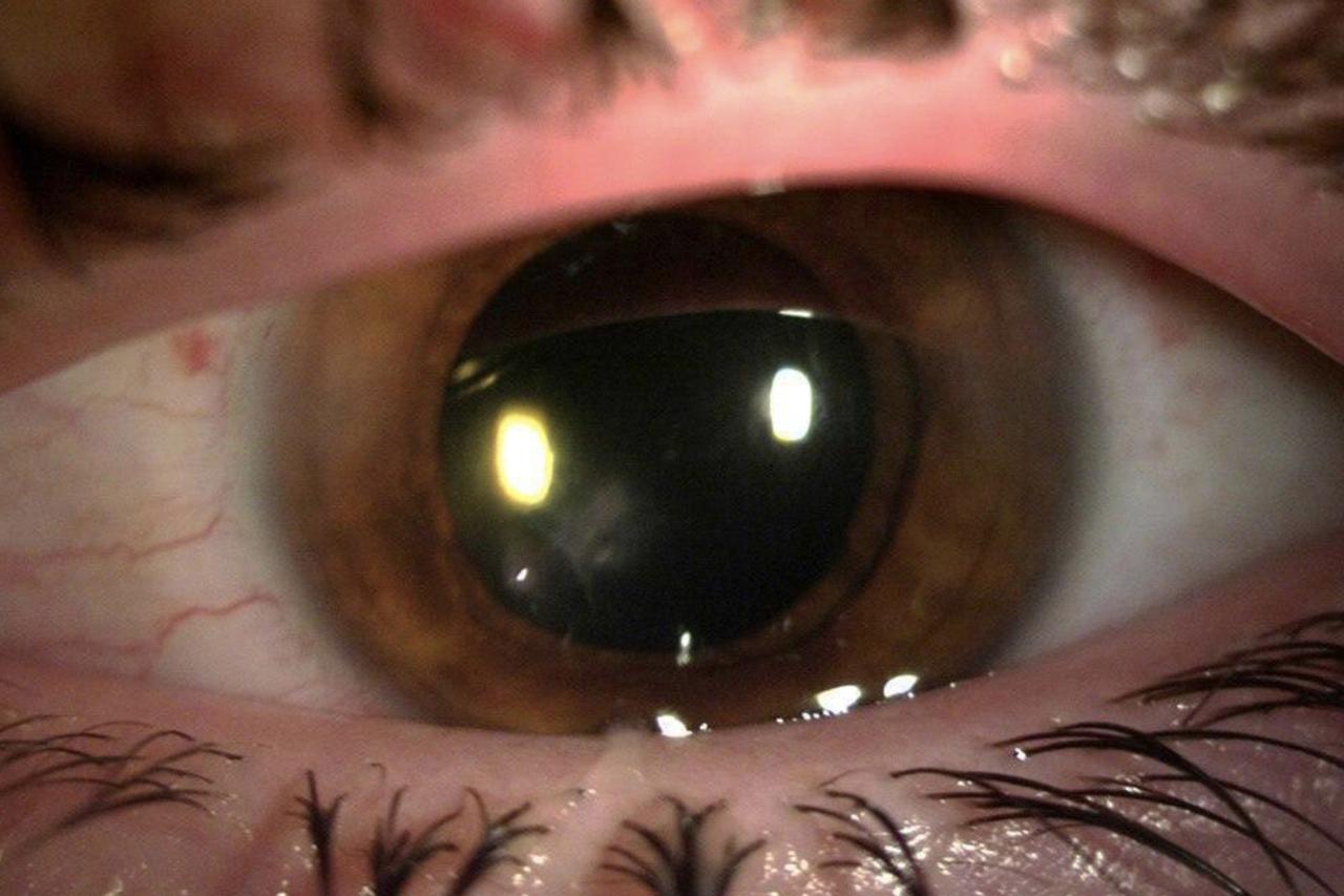 В Подмосковье школьник чуть не ослеп после опасной детской забавы