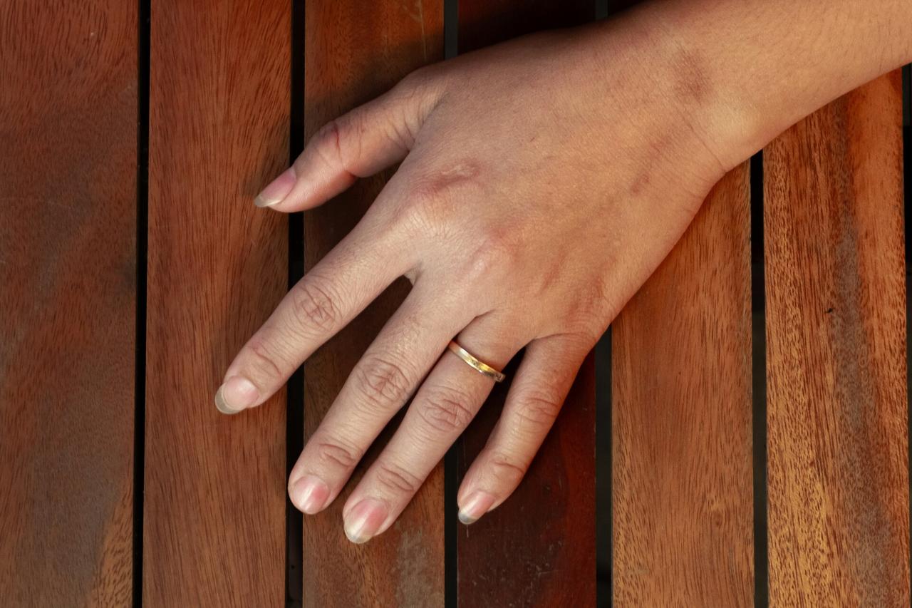 Москвичка оторвала себе палец кольцом