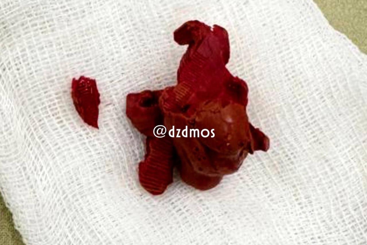 В мочевом пузыре любопытного москвича обнаружили пластилин размером с киви