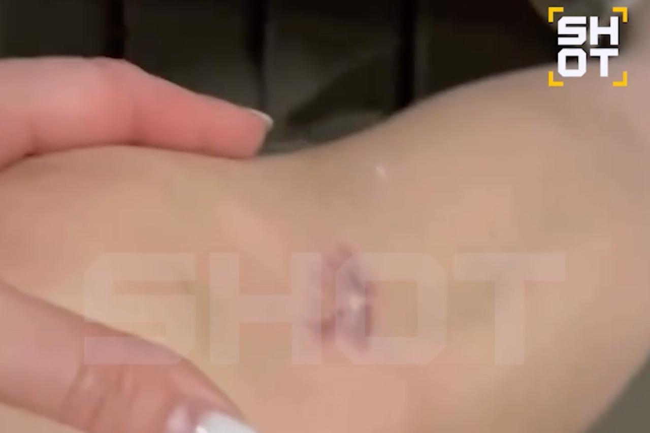 В Подмосковье корги прокусила женщине ногу