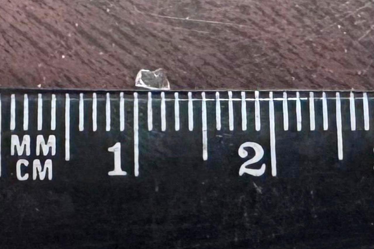 Житель Подмосковья после атаки дрона полтора года проходил с осколком в глазу