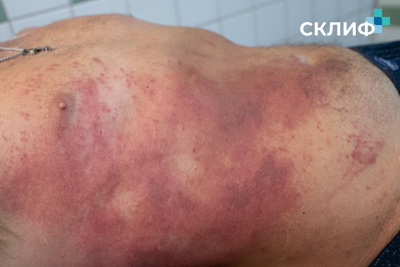Врачи обратились к москвичам с просьбой про борщевик