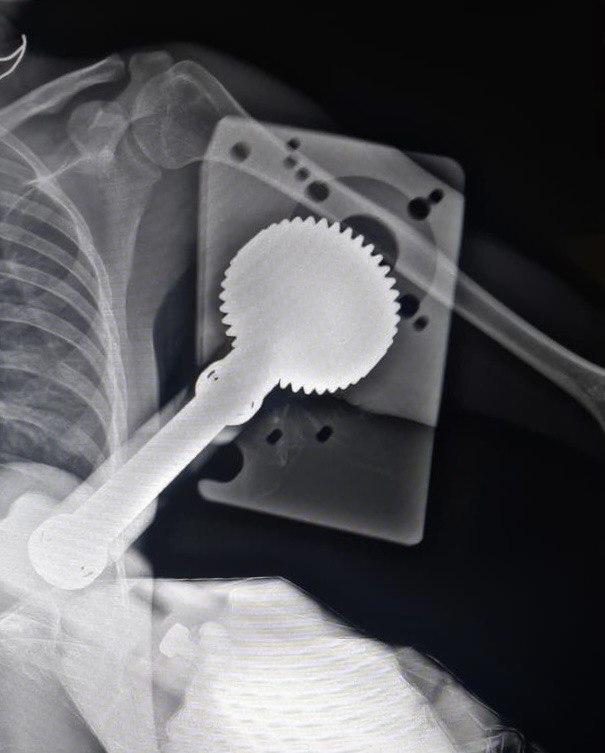 Руку жительницы Подмосковья затянуло в зернодробильную машину