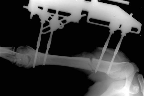 Врачи спасли укороченную опасной болезнью руку девушки