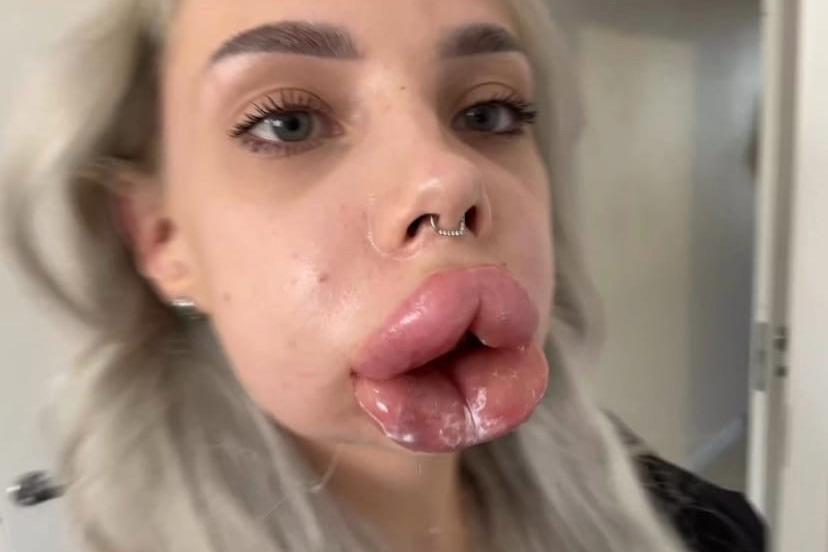 Москвичка показала видео с аллергической реакцией на удаление препарата из губ