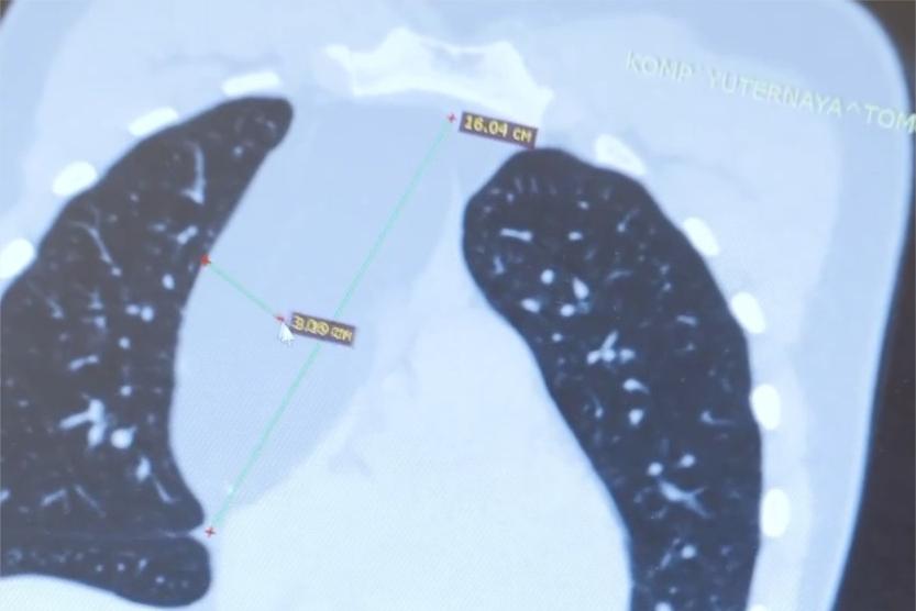 Подростку из Москвы удалили опухоль размером с кабачок