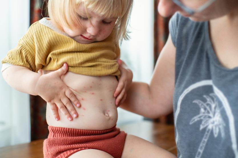 Родители стали специально заражать детей ветрянкой. Зачем они это делают?