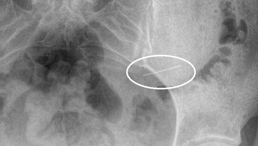Жительница Подмосковья проглотила швейную иглу