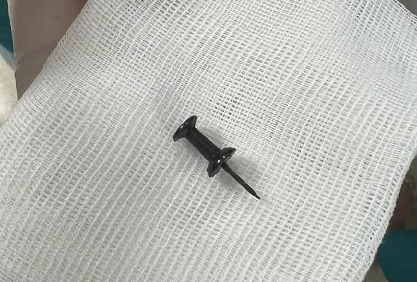 Подмосковные врачи достали из бронха подростка канцелярскую кнопку