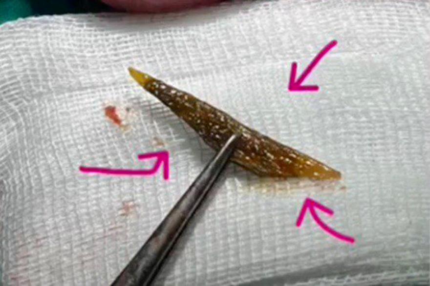 Мужчину с насквозь пробитой куриной костью кишкой спасли в Подмосковье