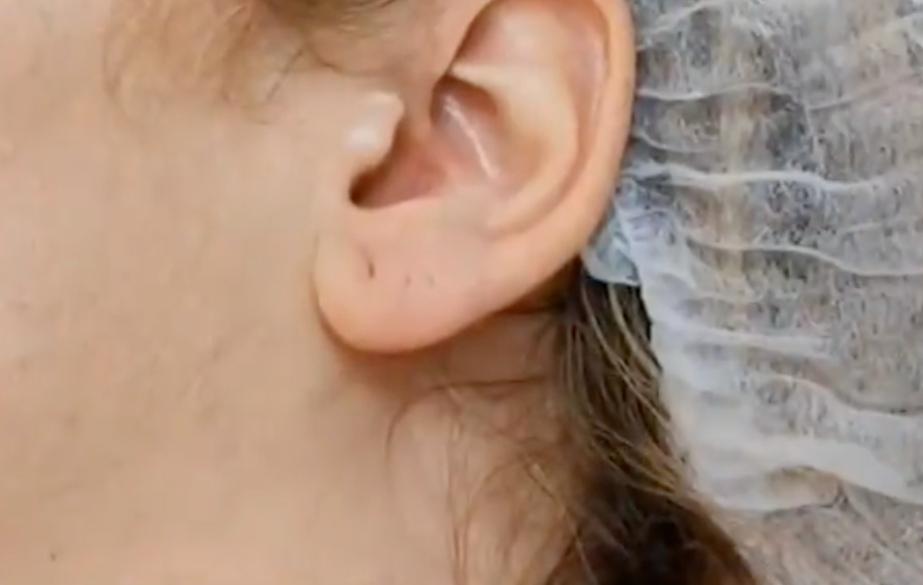 Москвички начали колоть ботокс в уши ради похудения