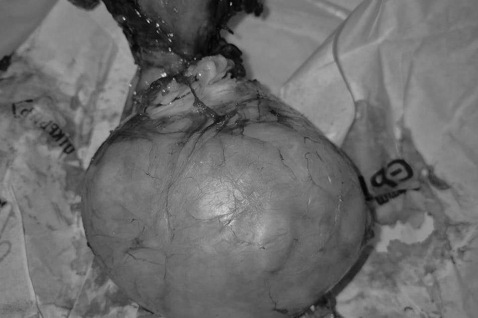 Жительнице Подмосковья удалили опухоль размером с волейбольный мяч