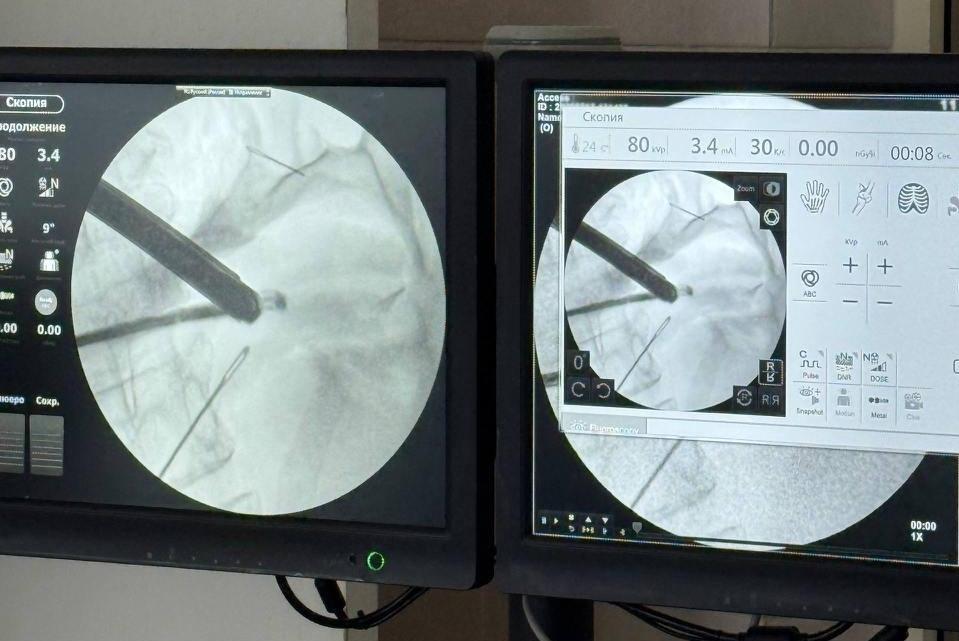 Подмосковные врачи спасли наглотавшуюся иголок женщину